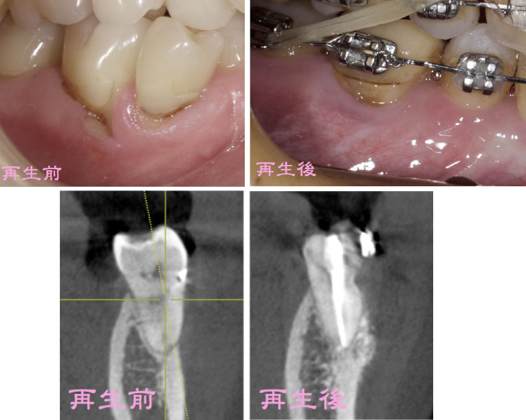 外科的歯周再生療法4