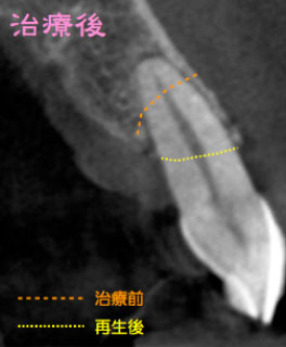 外科的歯周再生療法1