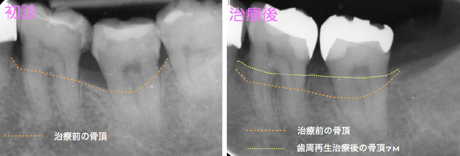 外科的歯周再生療法2